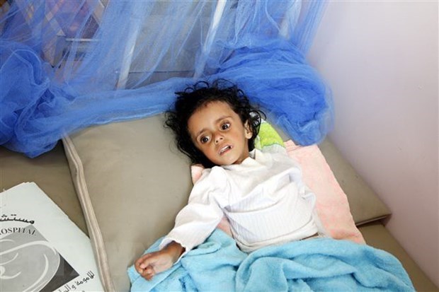 A malnourished child treated at a hospital in Sanaa, Yemen (Photo: Xinhua/VNA)