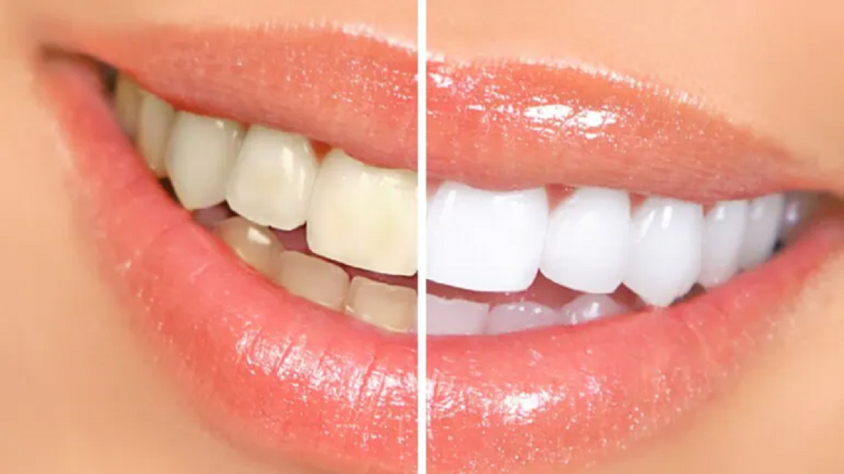 10 quy tắc để có hàm răng trắng bóng và chắc khỏe - Báo Long An Online