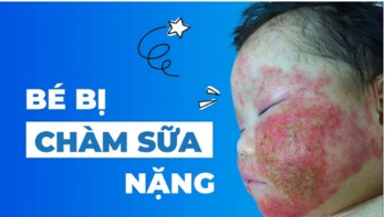 Bé bị chàm sữa nặng: Dấu hiệu - Nguyên nhân và cách phòng ngừa