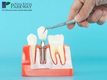 Trồng răng implant giá bao nhiêu 1 cái? Chi phí tại Parkway