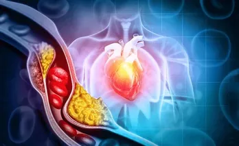 Dấu hiệu cholesterol cao đã chuyển thành bệnh nguy hiểm