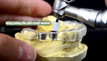 Cấy ghép Implant chính xác hơn gấp 11 lần với công nghệ định vị