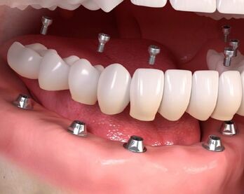 Làm răng Implant có nguy hiểm không? Biến chứng thường gặp là gì?