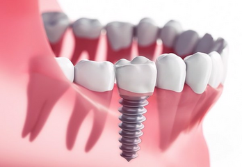 Trồng răng implant mất bao lâu thì lành?