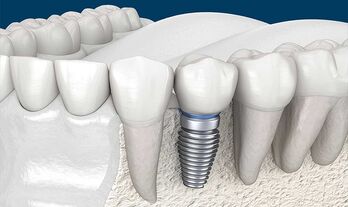 Lý giải nguyên nhân giá trồng răng implant cao hơn những phương pháp khác?